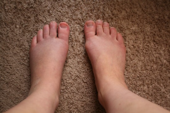 And apparently 8 weeks of disuse causes swelling and extreme dryness.  (I spent over five minutes in the shower just scrubbing off dead skin on the left foot!)